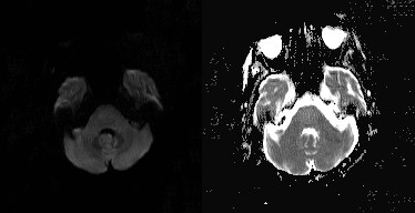 渗透性髓鞘溶解及其影像解析