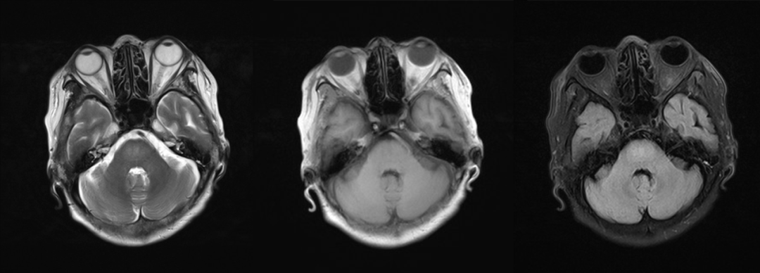 渗透性髓鞘溶解及其影像解析