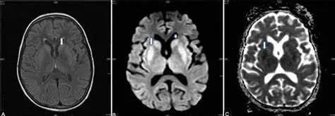 渗透性髓鞘溶解及其影像解析