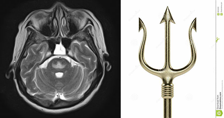 渗透性髓鞘溶解及其影像解析