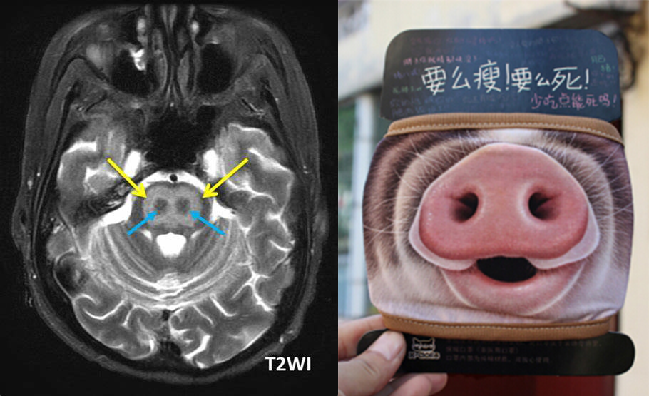 渗透性髓鞘溶解及其影像解析