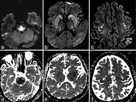 渗透性髓鞘溶解及其影像解析