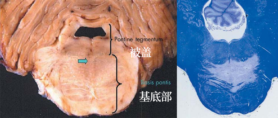 渗透性髓鞘溶解及其影像解析