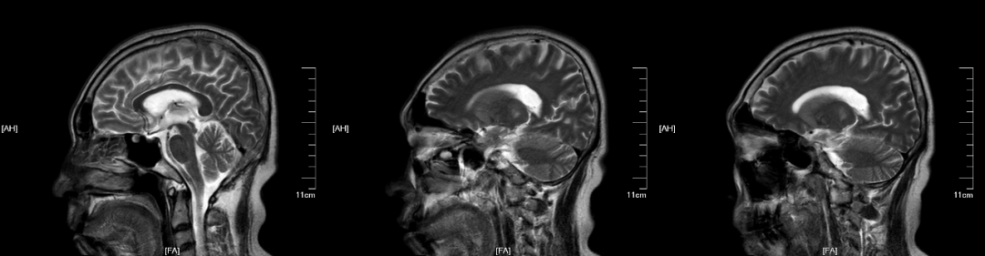 渗透性髓鞘溶解及其影像解析