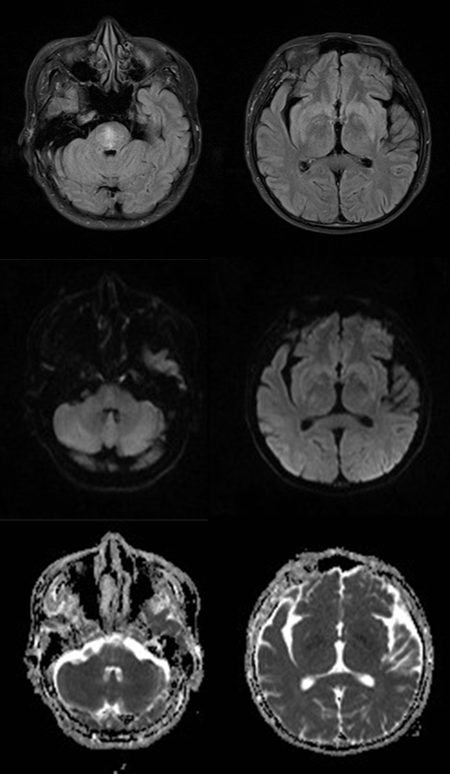 渗透性髓鞘溶解及其影像解析