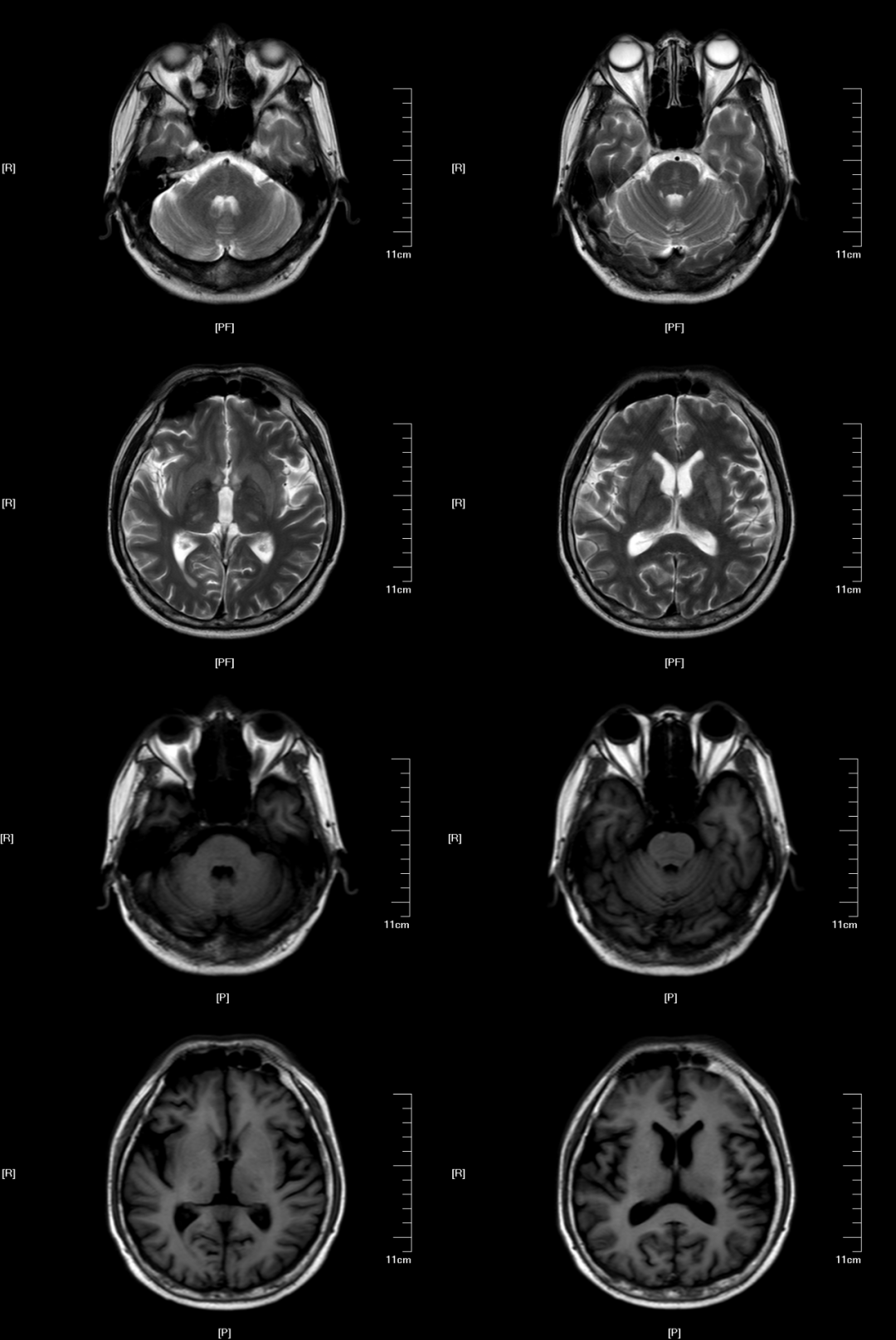渗透性髓鞘溶解及其影像解析