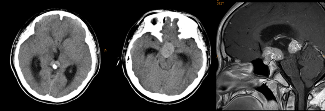 3 大类儿童松果体区肿瘤，您会诊断吗？