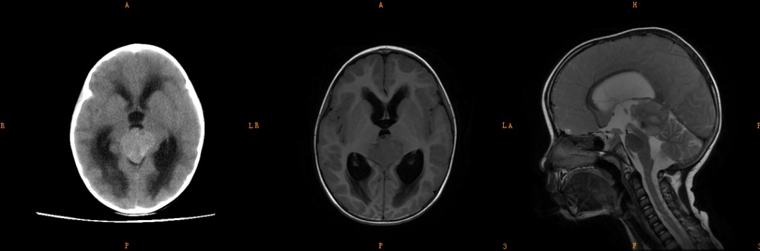 3 大类儿童松果体区肿瘤，您会诊断吗？