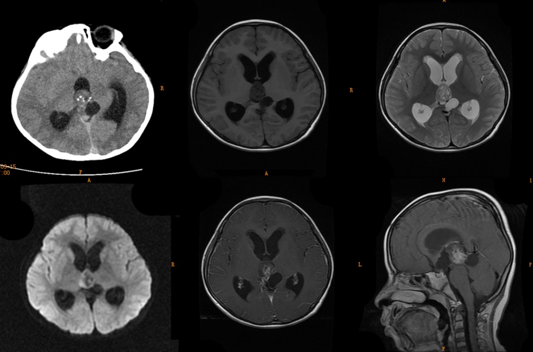 3 大类儿童松果体区肿瘤，您会诊断吗？