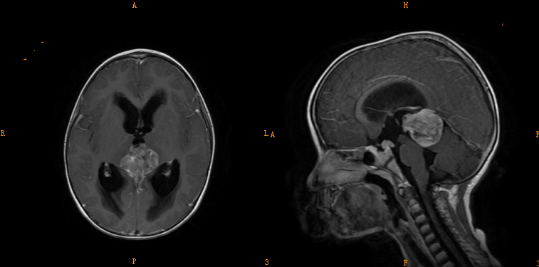 3 大类儿童松果体区肿瘤，您会诊断吗？