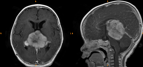 3 大类儿童松果体区肿瘤，您会诊断吗？