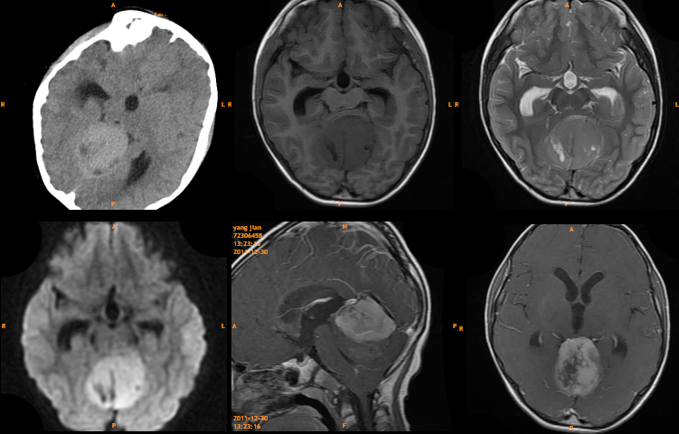 3 大类儿童松果体区肿瘤，您会诊断吗？