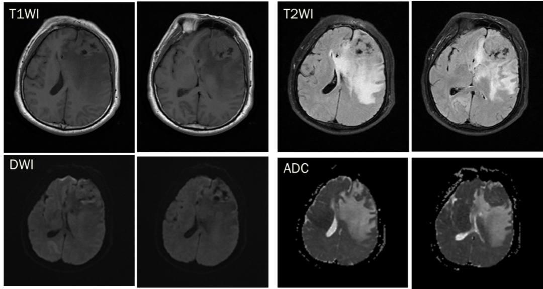 脑膜瘤与血管外皮瘤的 MRI 诊断与鉴别诊断