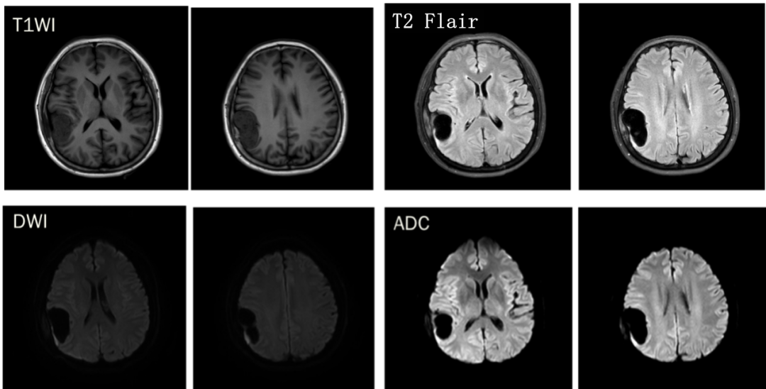 脑膜瘤与血管外皮瘤的 MRI 诊断与鉴别诊断