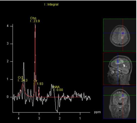 脑膜瘤与血管外皮瘤的 MRI 诊断与鉴别诊断