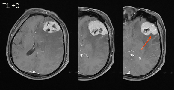 脑膜瘤与血管外皮瘤的 MRI 诊断与鉴别诊断