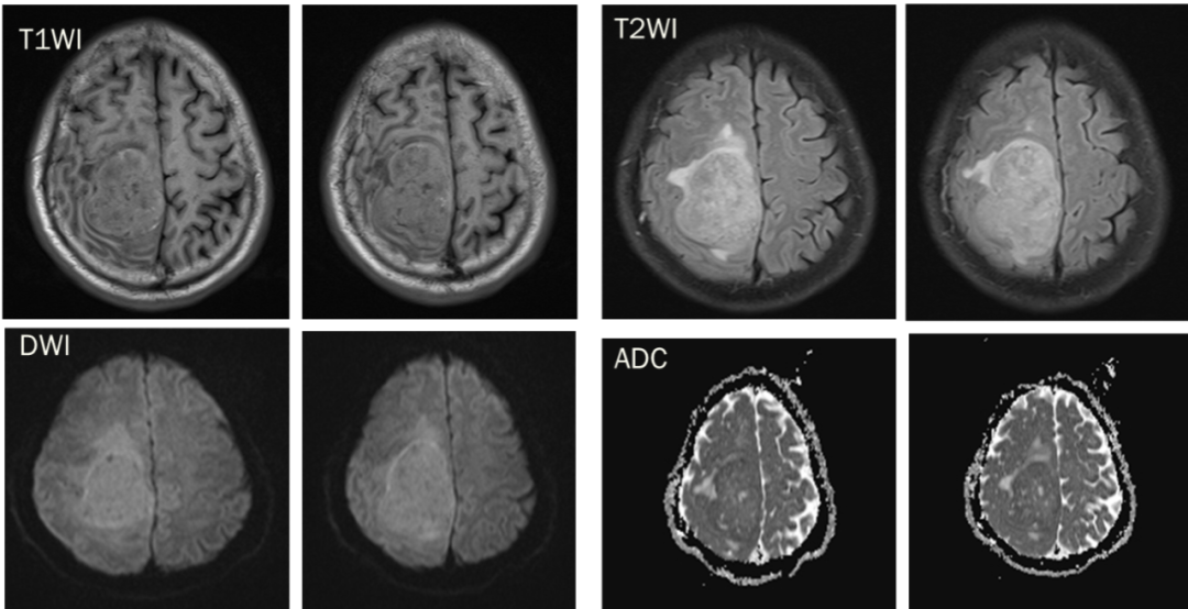 脑膜瘤与血管外皮瘤的 MRI 诊断与鉴别诊断
