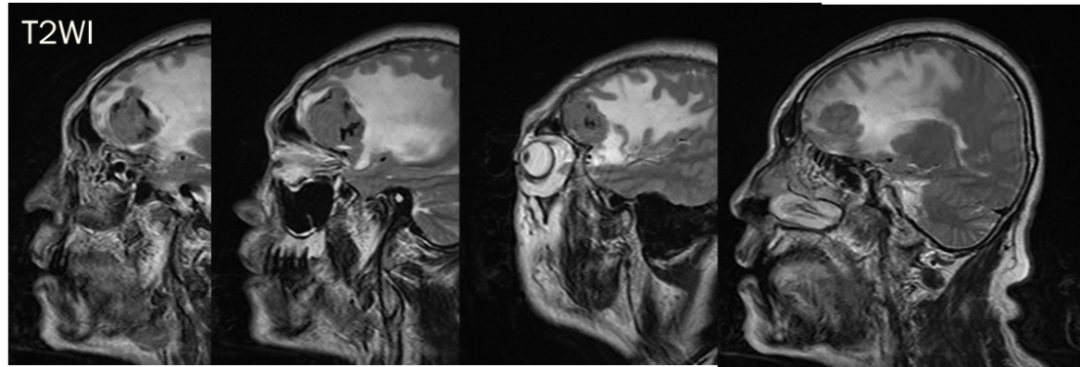 脑膜瘤与血管外皮瘤的 MRI 诊断与鉴别诊断