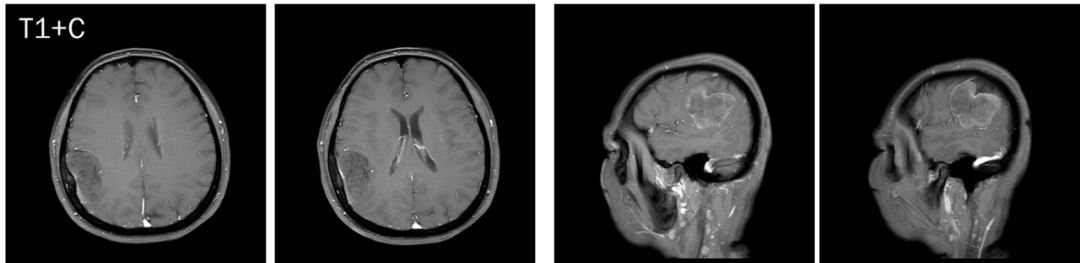 脑膜瘤与血管外皮瘤的 MRI 诊断与鉴别诊断