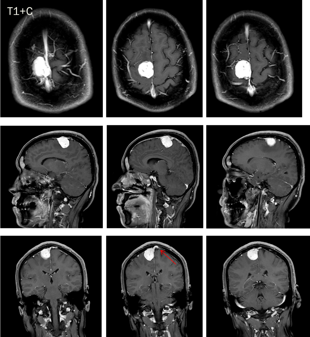 脑膜瘤与血管外皮瘤的 MRI 诊断与鉴别诊断