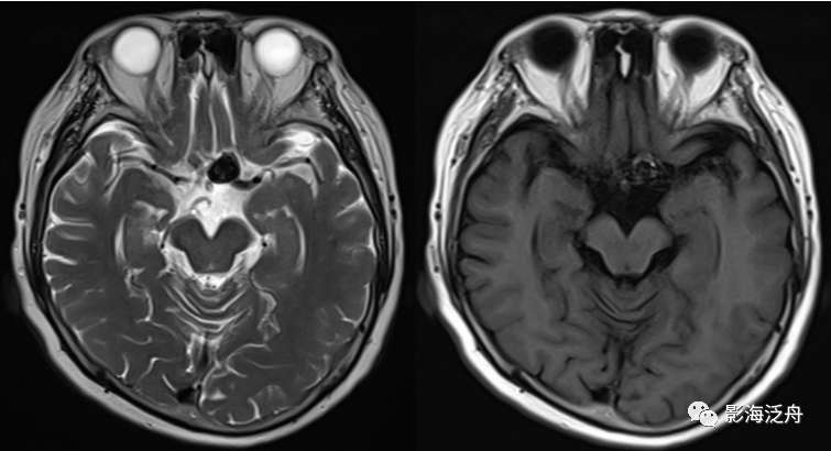 颅脑MR平扫中极易漏诊的点-3