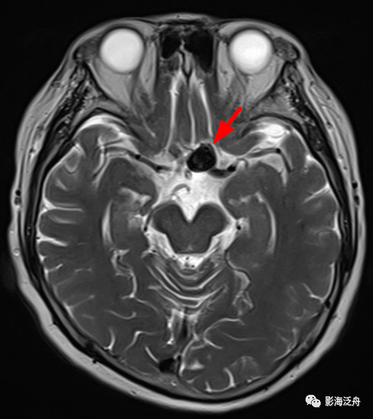 颅脑MR平扫中极易漏诊的点-8