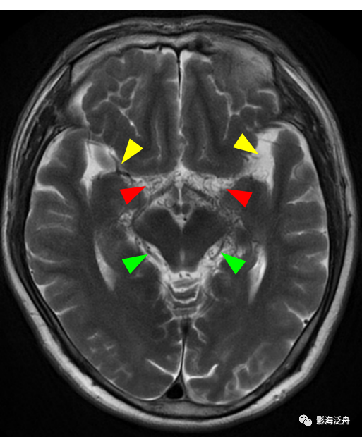 颅脑MR平扫中极易漏诊的点-7