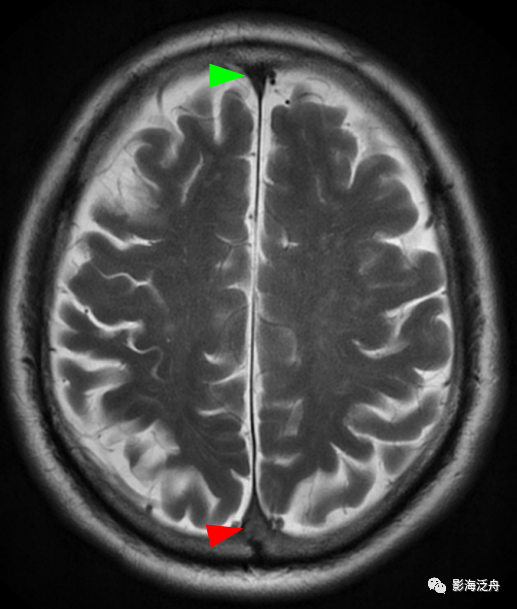 颅脑MR平扫中极易漏诊的点-9
