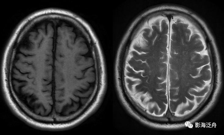 颅脑MR平扫中极易漏诊的点-5