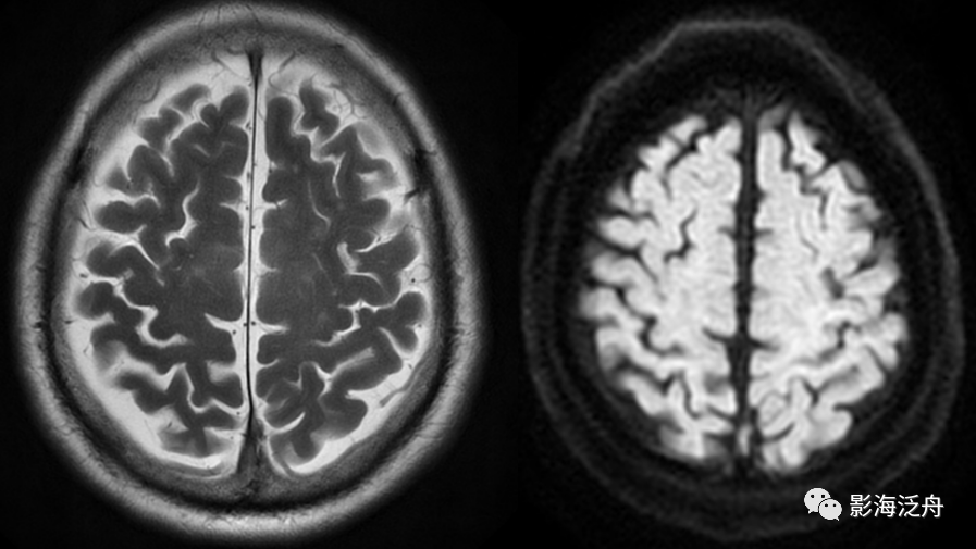 颅脑MR平扫中极易漏诊的点-6
