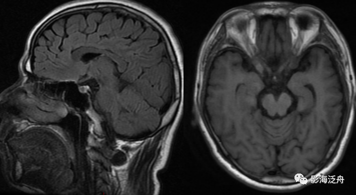 颅脑MR平扫中极易漏诊的点-2