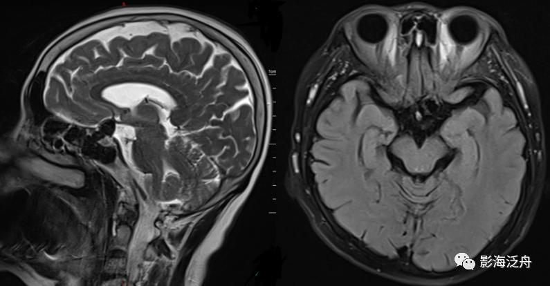 颅脑MR平扫中极易漏诊的点-4