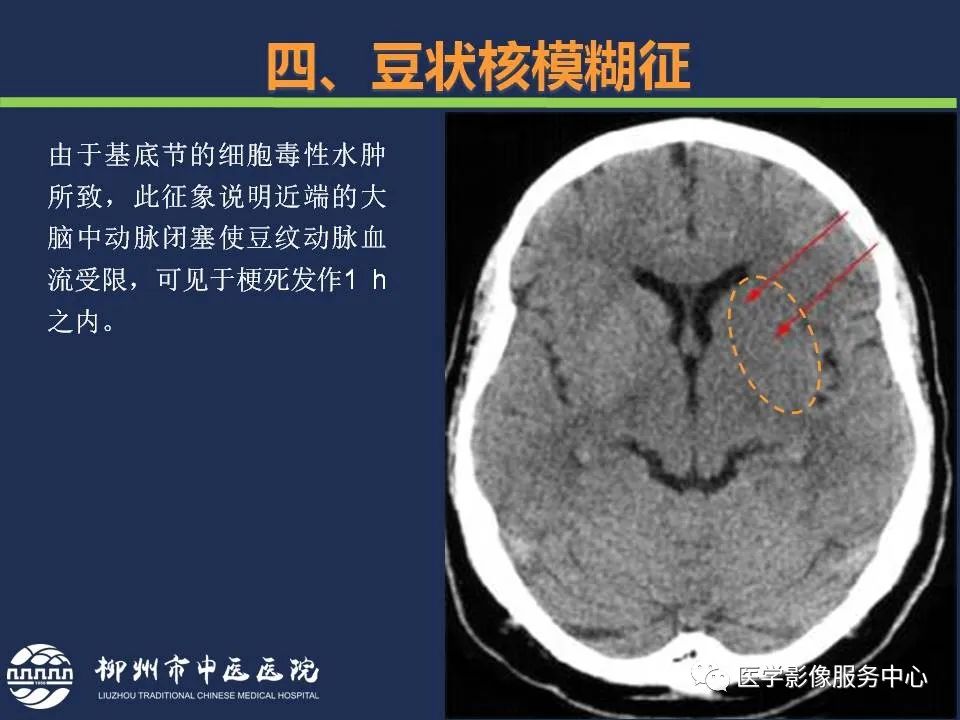 【PPT】超早期脑梗死CT征象-47