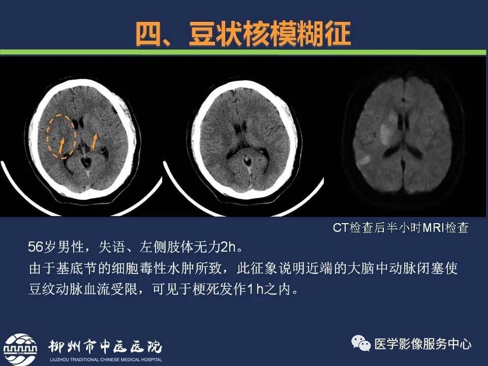 【PPT】超早期脑梗死CT征象-48