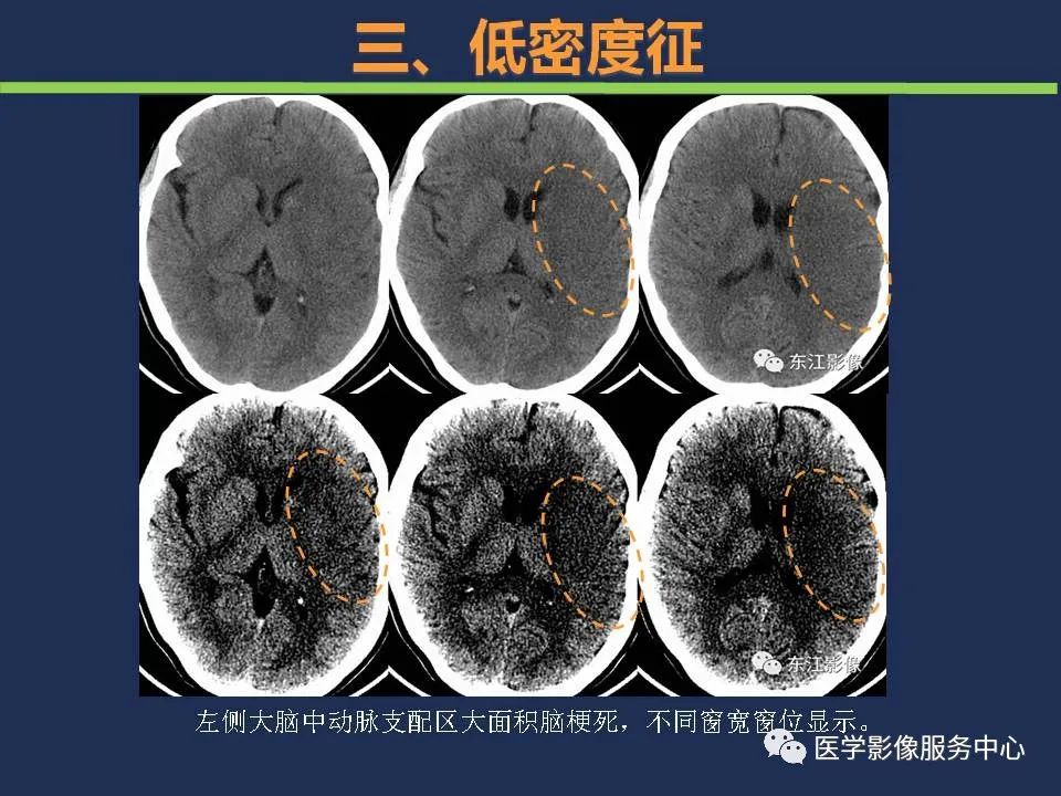 【PPT】超早期脑梗死CT征象-44