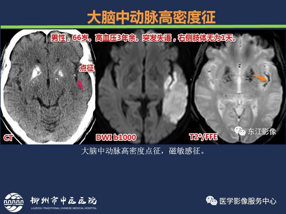 【PPT】超早期脑梗死CT征象-16