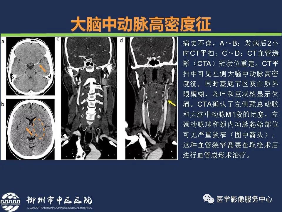 【PPT】超早期脑梗死CT征象-18