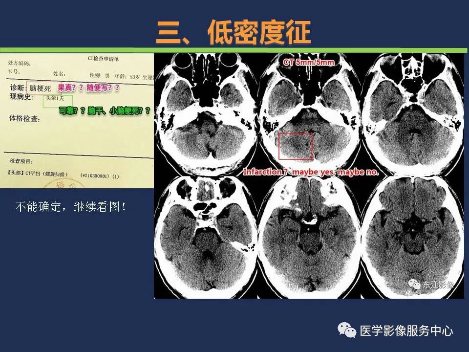 【PPT】超早期脑梗死CT征象-33