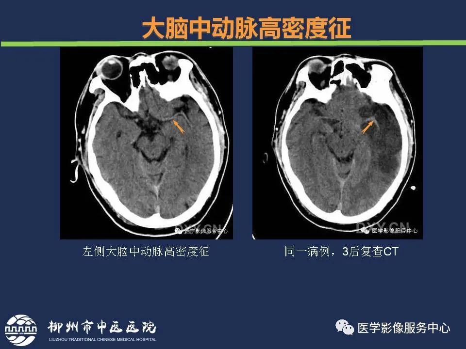【PPT】超早期脑梗死CT征象-15