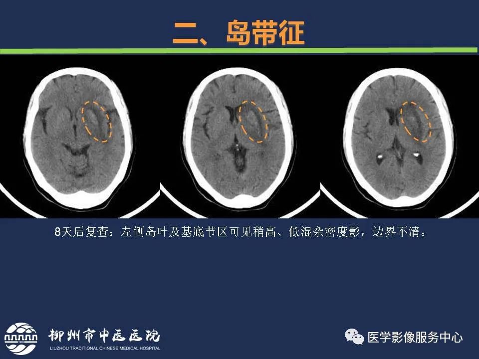 【PPT】超早期脑梗死CT征象-27