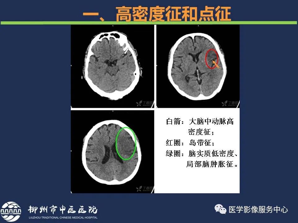 【PPT】超早期脑梗死CT征象-12