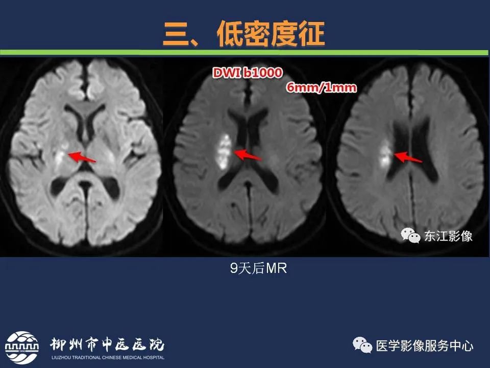 【PPT】超早期脑梗死CT征象-36