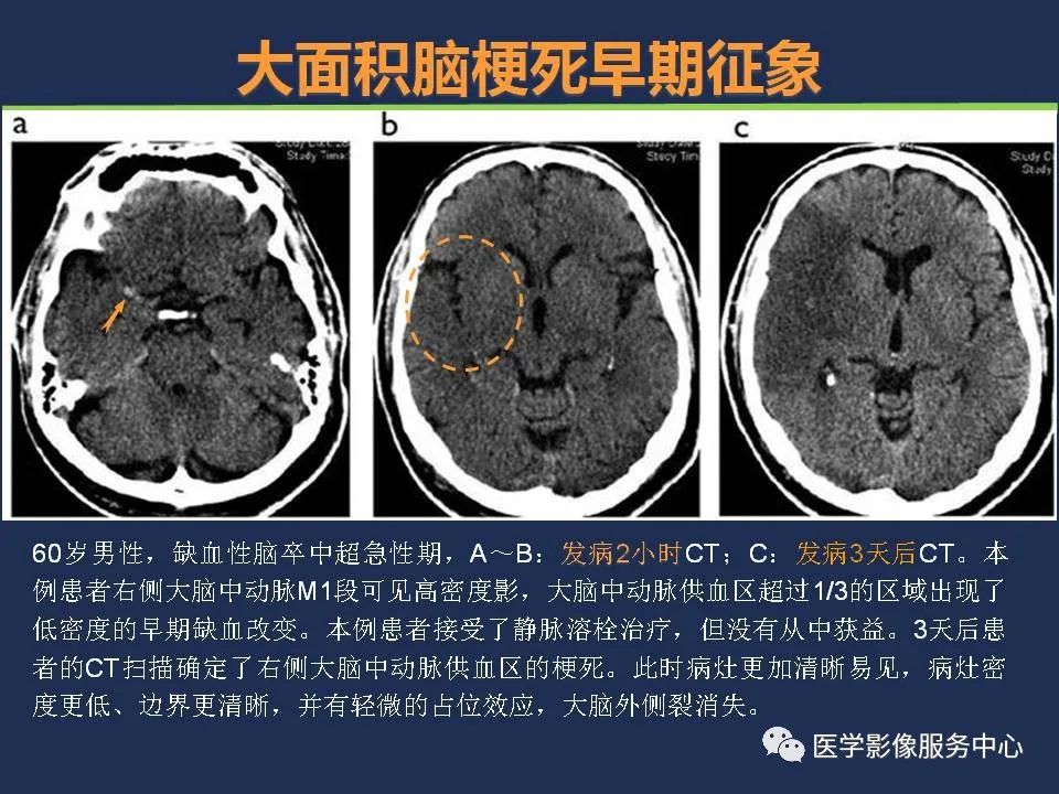 【PPT】超早期脑梗死CT征象-21