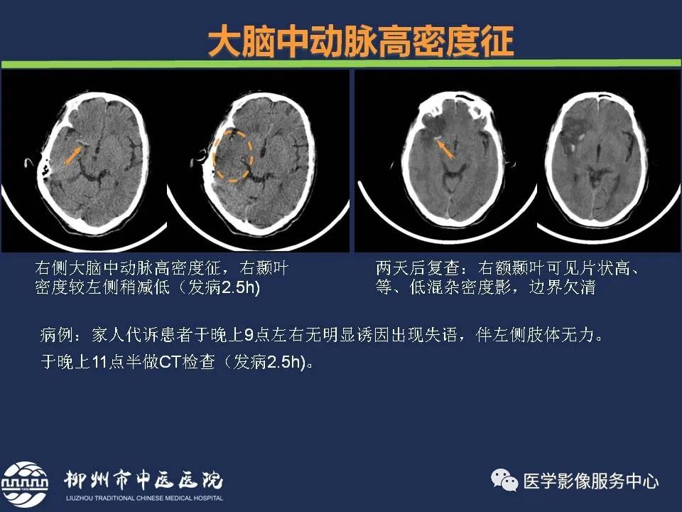 【PPT】超早期脑梗死CT征象-13