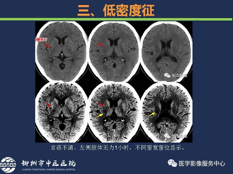 【PPT】超早期脑梗死CT征象-45