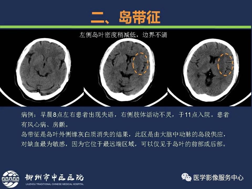 【PPT】超早期脑梗死CT征象-26