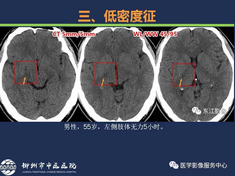 【PPT】超早期脑梗死CT征象-40