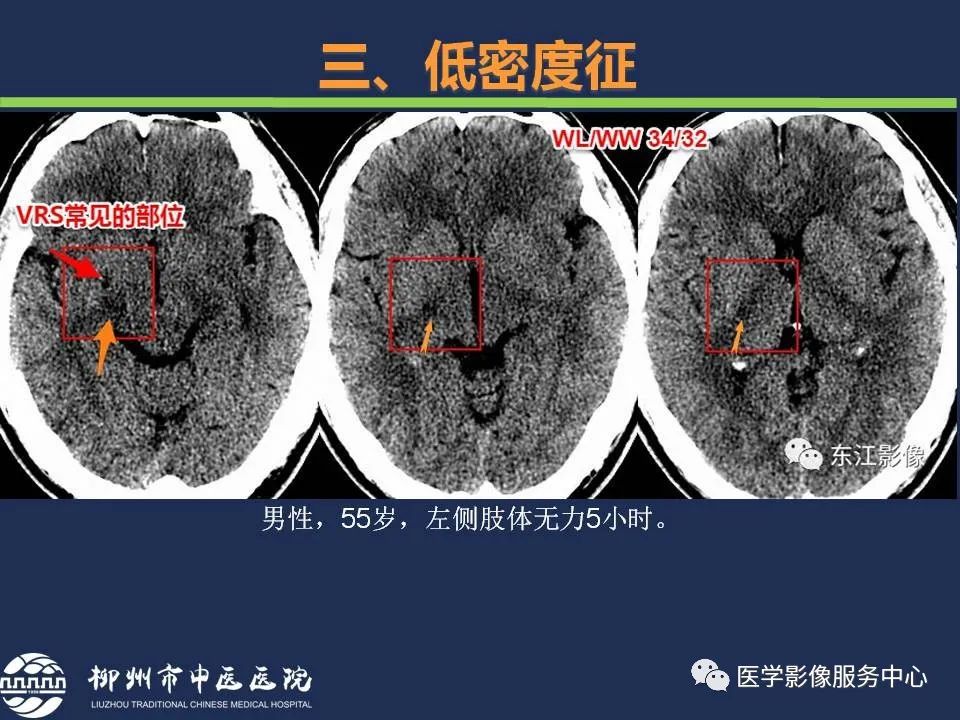 【PPT】超早期脑梗死CT征象-41