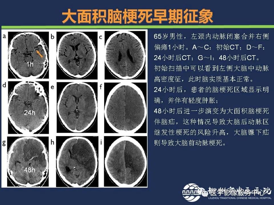 【PPT】超早期脑梗死CT征象-22