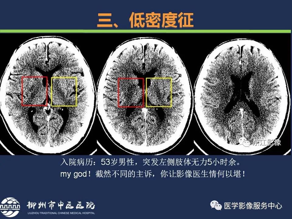 【PPT】超早期脑梗死CT征象-35